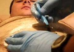 Pre-catheter shave. two