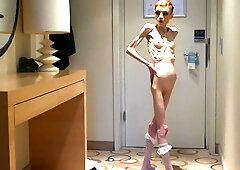 Anorexia Christin showing her Bones & Skinny Skeleton